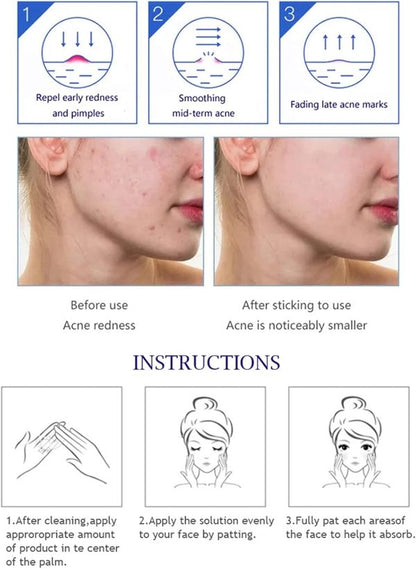 Aichun Beauty Anti – Acne Whitening Facial Serum